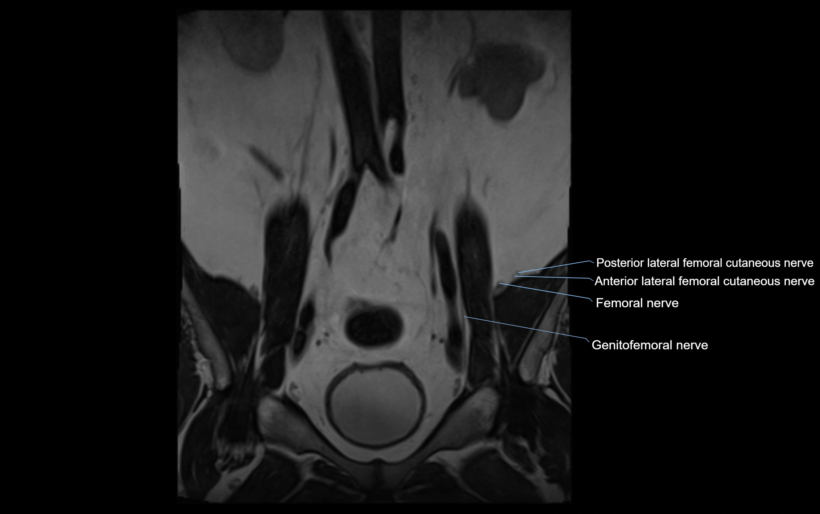 MR lumbosacral plexus cross sectional anatomy 3T  radiology  image-img-09001-00004.webp